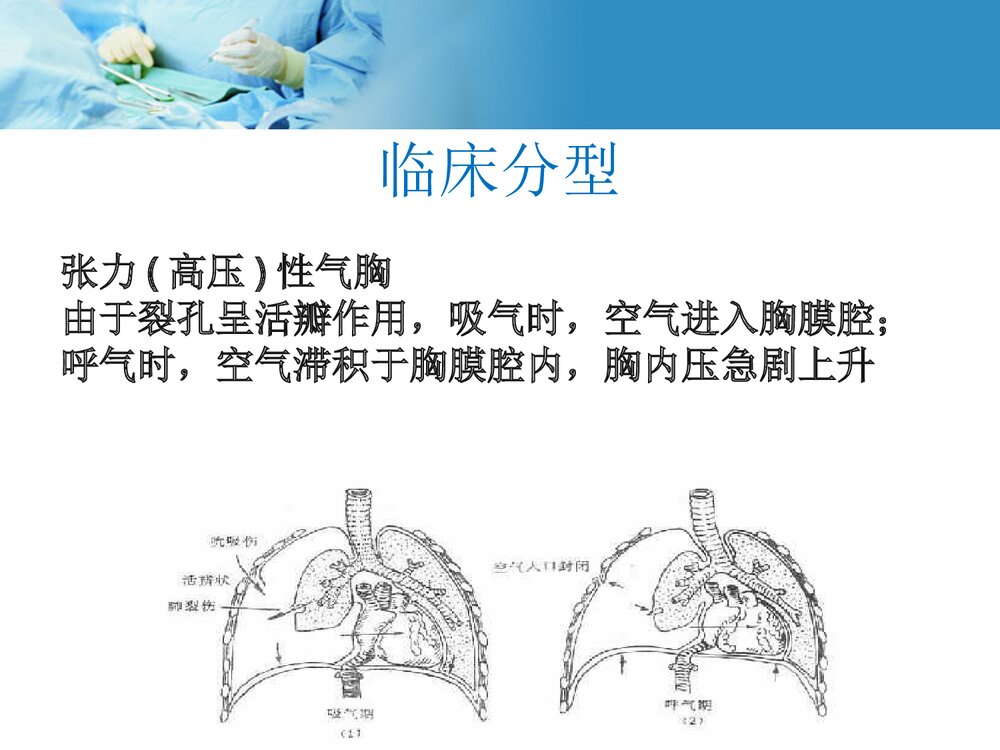自发性气胸护理教学查房PPT课件下载7