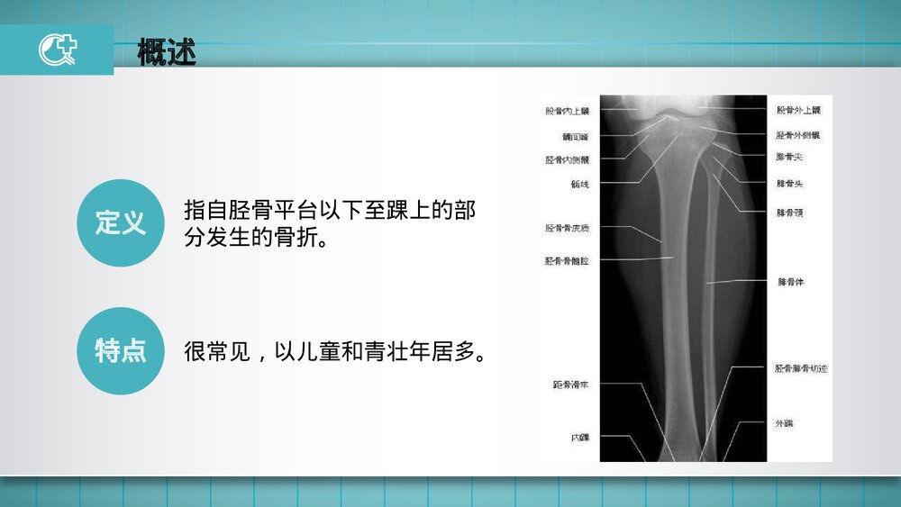 胫腓骨骨折的护理PPT课件(共23页·可编辑修改)5