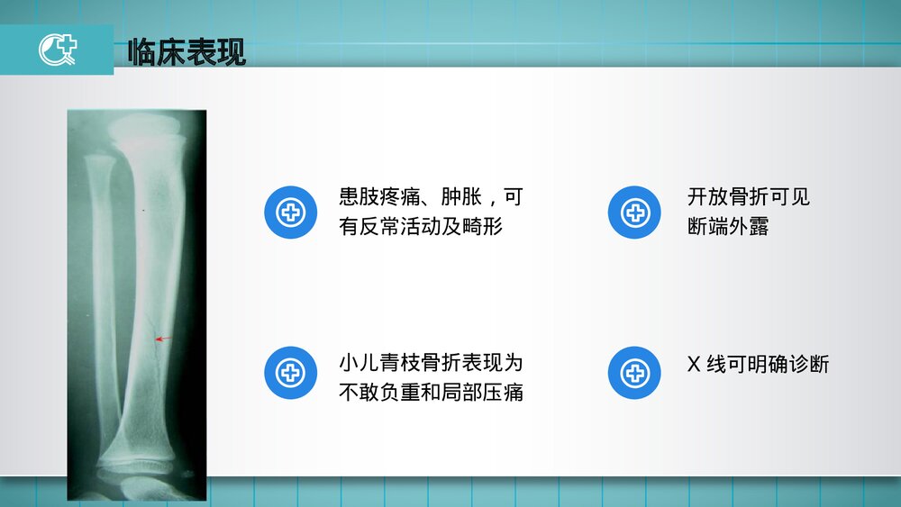 胫腓骨骨折的护理PPT课件(共23页·可编辑修改)9