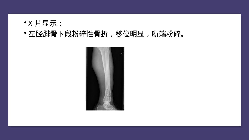 胫腓骨骨折中医护理查房PPT课件(共43页)7