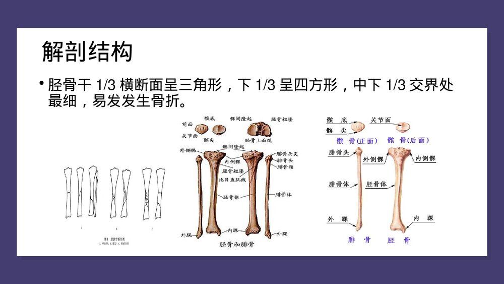 胫腓骨骨折中医护理查房PPT课件(共43页)9