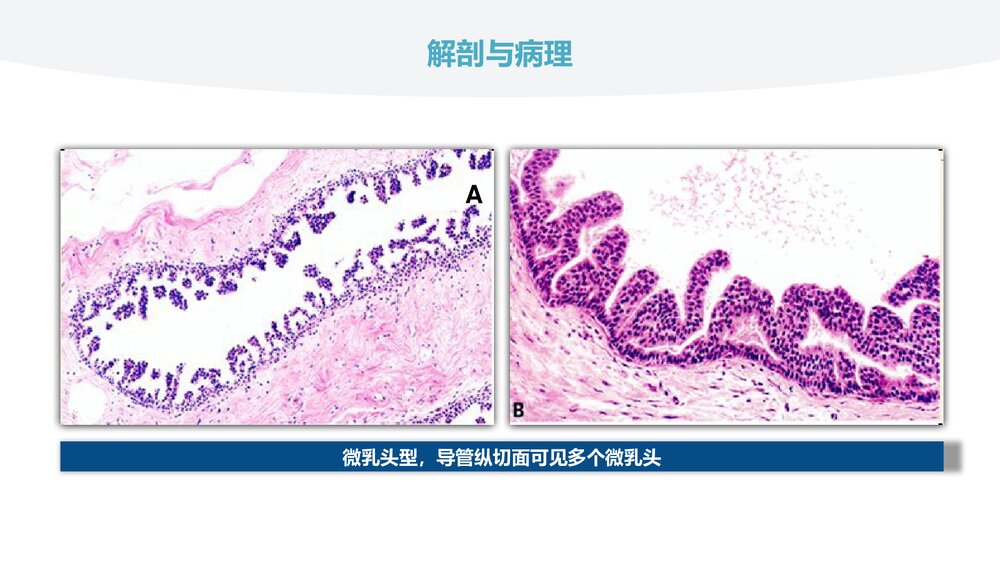 乳腺导管原位癌的超声诊断PPT课件(共31页)8