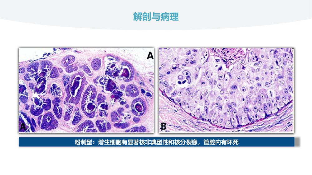 乳腺导管原位癌的超声诊断PPT课件(共31页)10