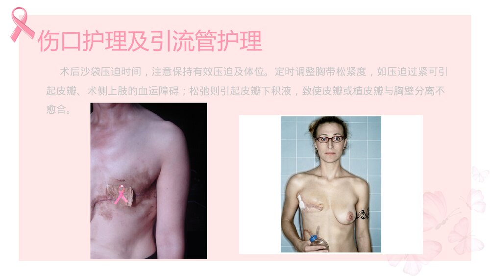 乳腺癌患者术后护理PPT课件下载(共13页)4
