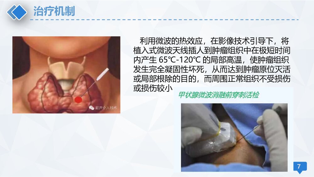 甲状腺微波消融术护理PPT课件下载(共13页·可编辑修改)7