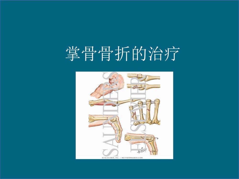 掌骨骨折的治疗PPT课件下载(共48页·可编辑修改)1