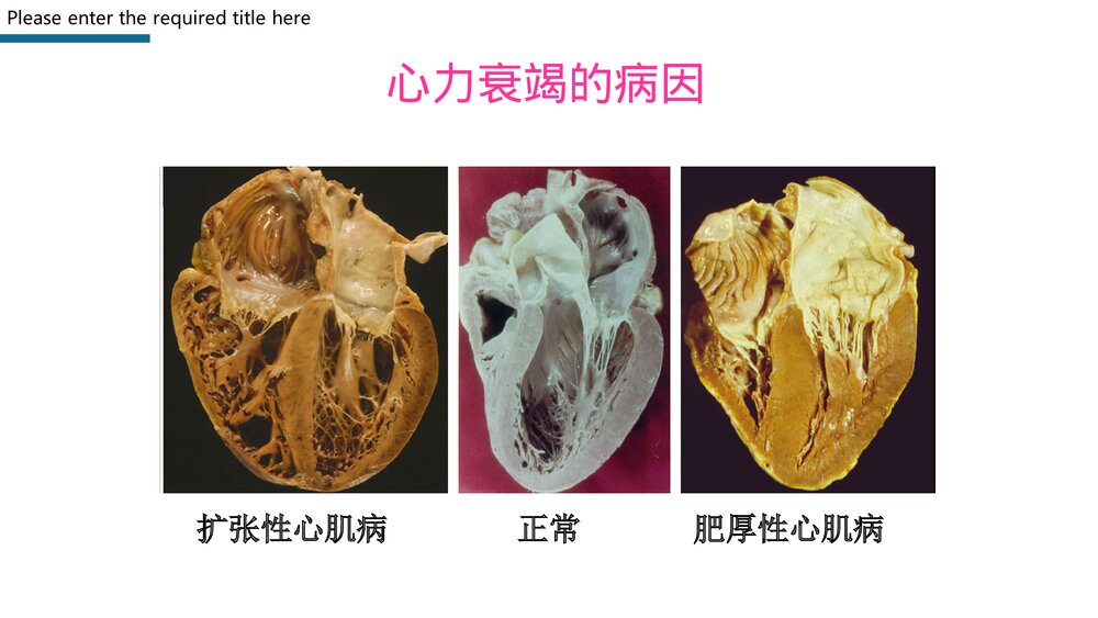 心力衰竭护理查房PPT课件下载7
