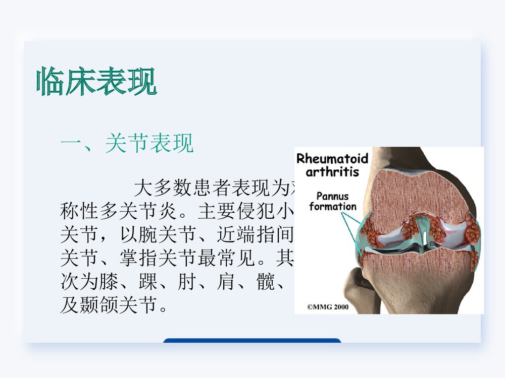 类风湿关节炎的护理查房PPT课件下载4