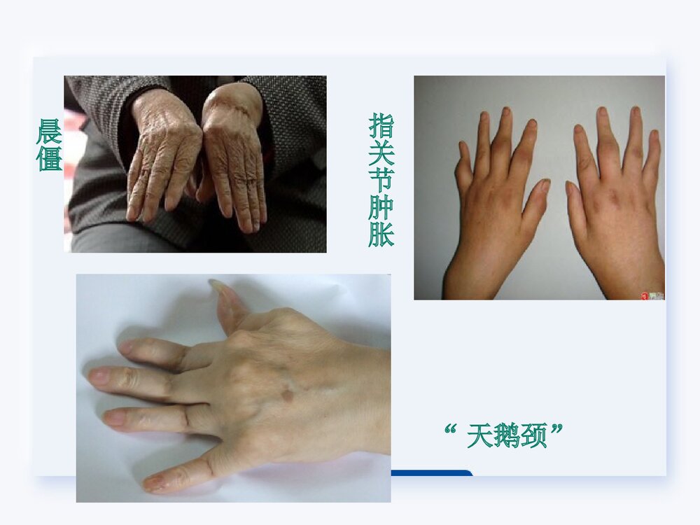 类风湿关节炎的护理查房PPT课件下载7