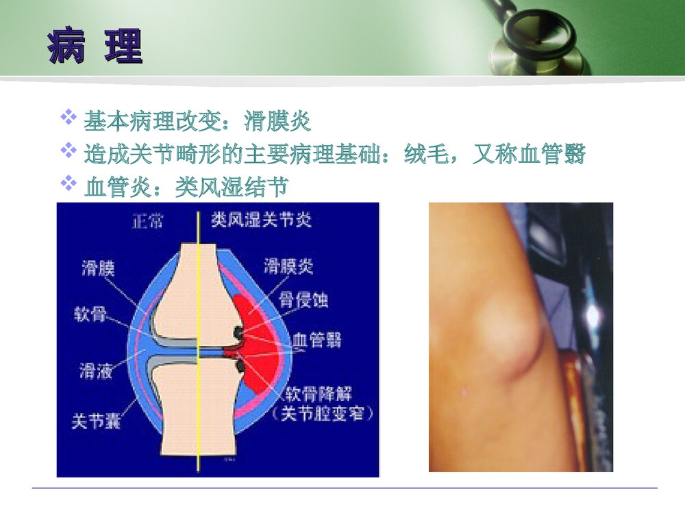类风湿性关节炎病人的护理PPT课件下载7