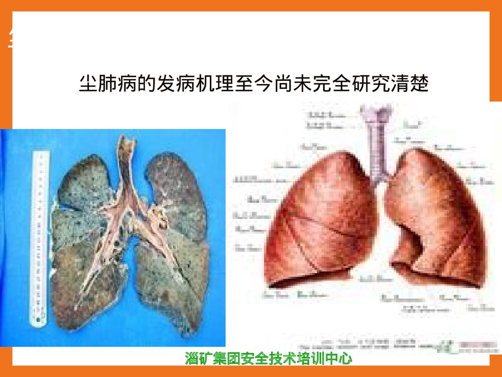 焊接工尘肺病的预防PPT课件下载10