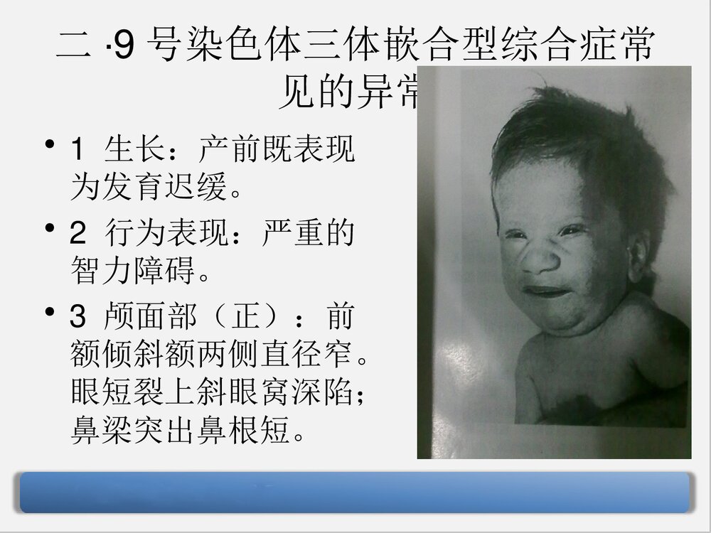 9号染色体三体嵌合型综合症PPT课件下载7