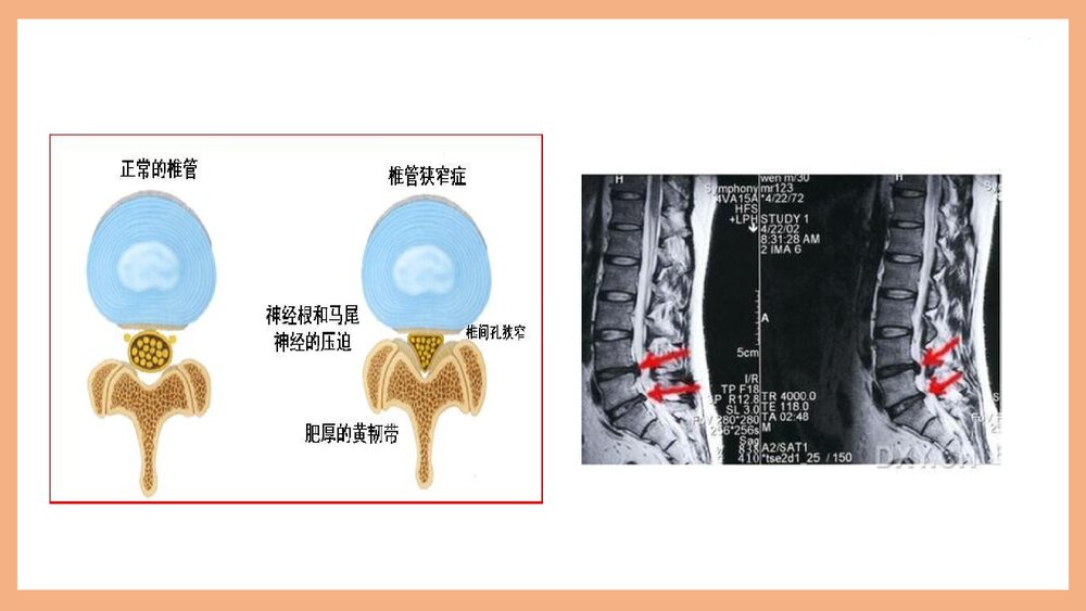 腰椎管狭窄护理PPT课件(共37页·可编辑修改)7