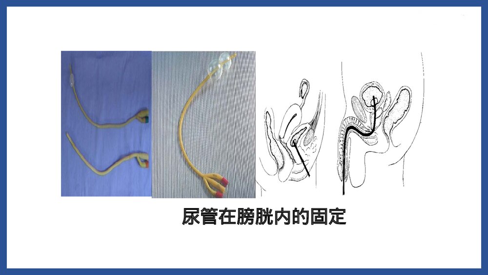 膀胱冲洗PPT课件下载10