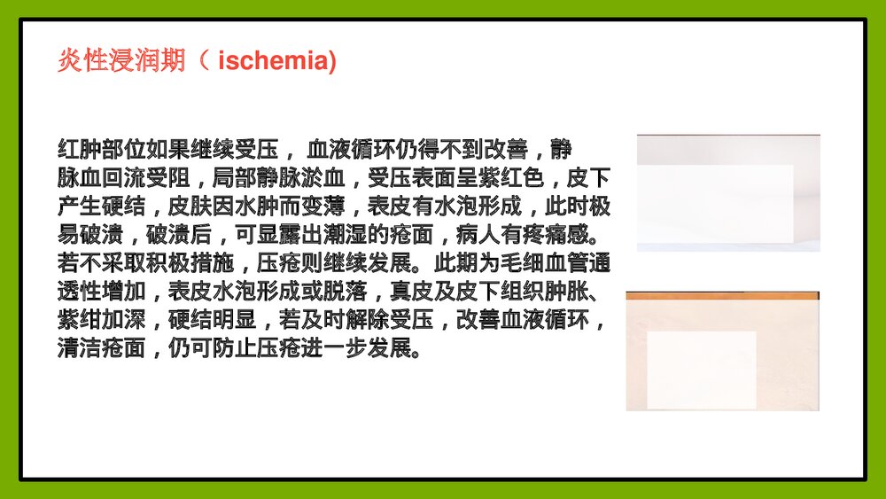压疮的护理方法PPT课件8