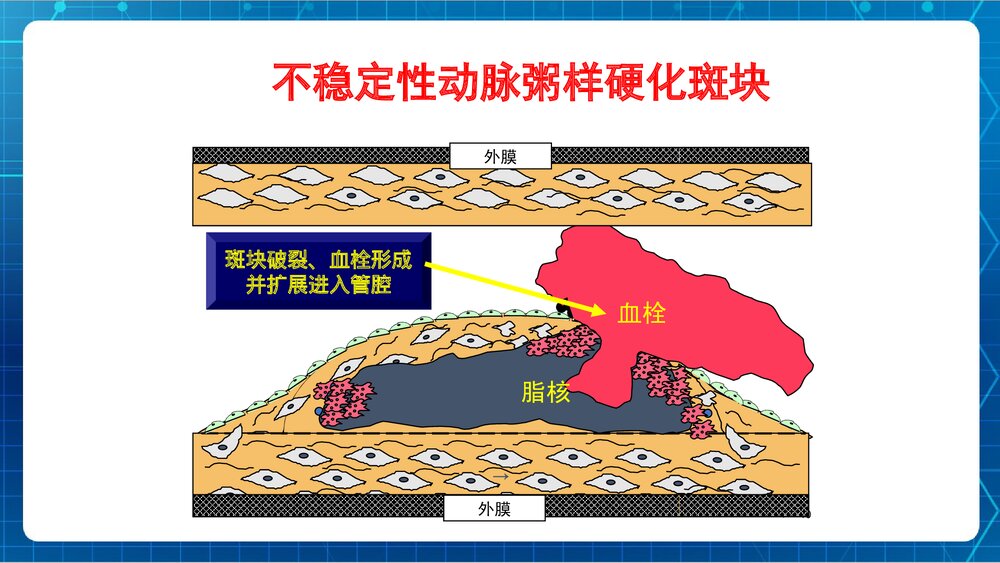 冠心病教学课件PPT下载 ppt10
