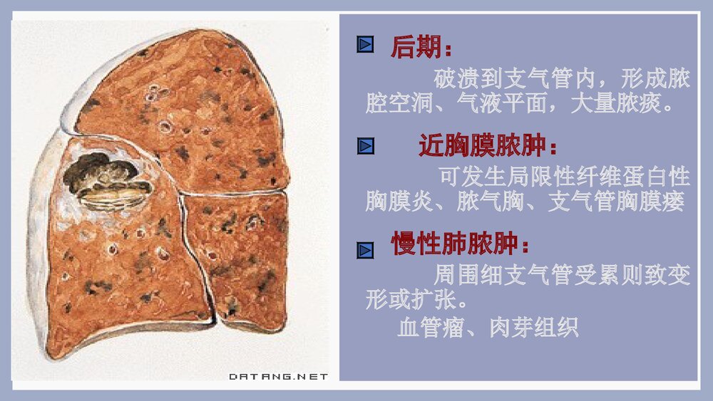 肺脓肿的临床表现及治疗PPT课件下载10